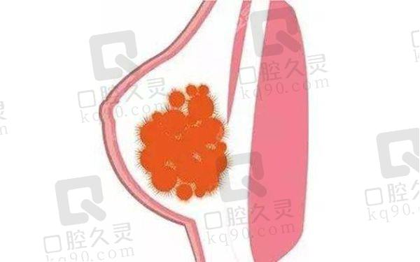 上海谢卫国注射隆胸取出真实实例