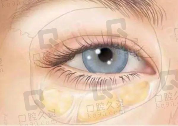 广州健丽去眼袋怎么样