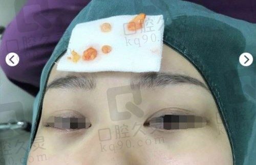 广州健丽去眼袋评价