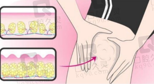 武汉富贵包手术哪个医院做的好