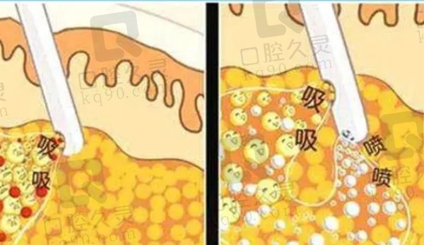 武汉富贵包手术哪个医院做的好