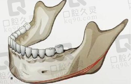 广州韩妃柳超医生磨骨怎么样？