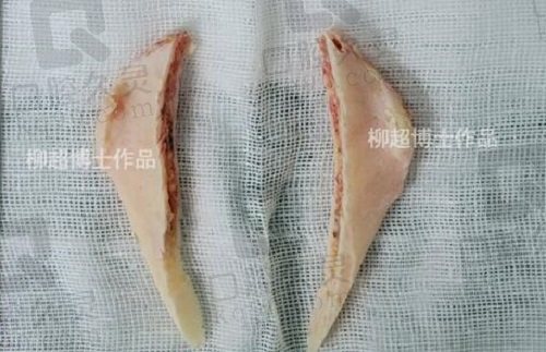 广州韩妃柳超医生磨骨怎么样？