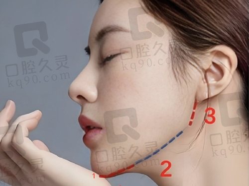 广州韩妃柳超医生怎么样？