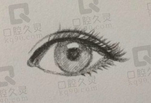 长沙张娇娇双眼皮修复失败范例基本没有