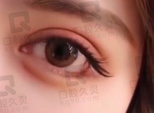 长沙张娇娇双眼皮修复失败范例基本没有