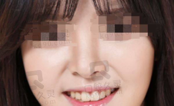 新疆乌鲁木齐华美整形医院鼻修复怎么样