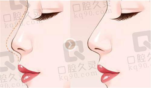 邓裴医生做鼻子多少钱