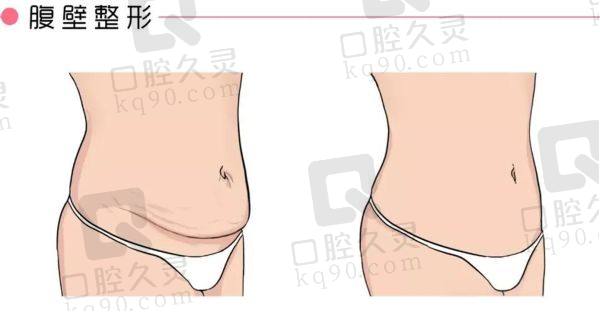 成都李献和腹壁成形术怎么样