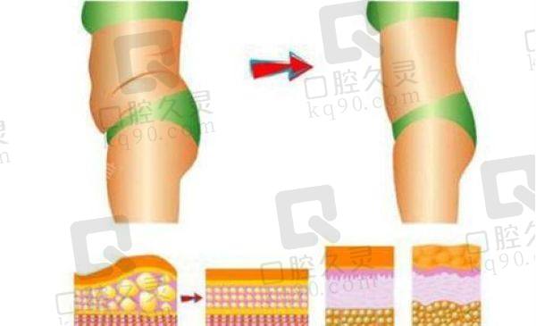 李献和做腹壁成形手术要多少钱