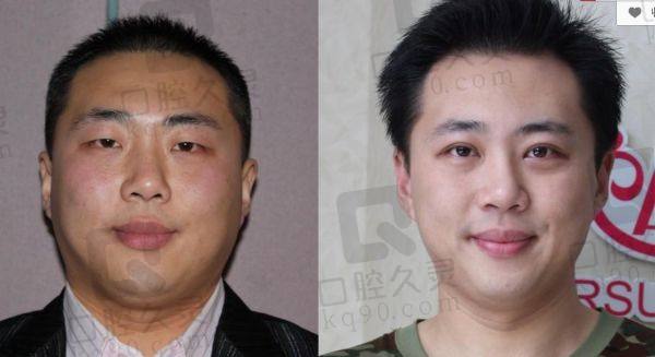 南京李国伟医生面部吸脂怎么样