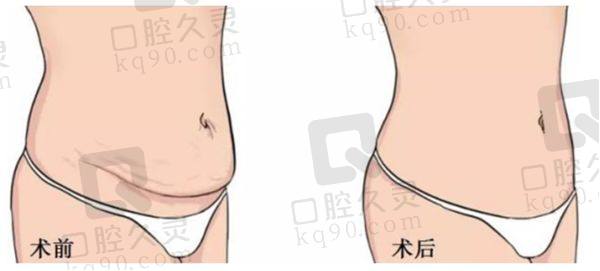 重庆刘彦龙吸脂【 】怎么样