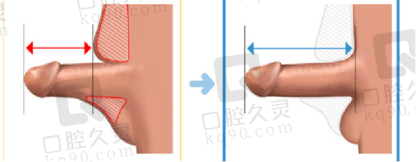 李世荣做生物补片增粗怎么样