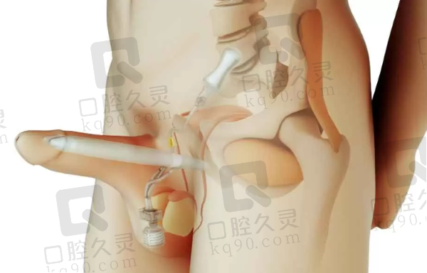 李世荣做生物补片增粗价格