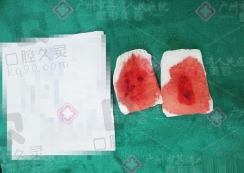 广州荔医清奥馒化脸修复全息6维层离清奥术3.0