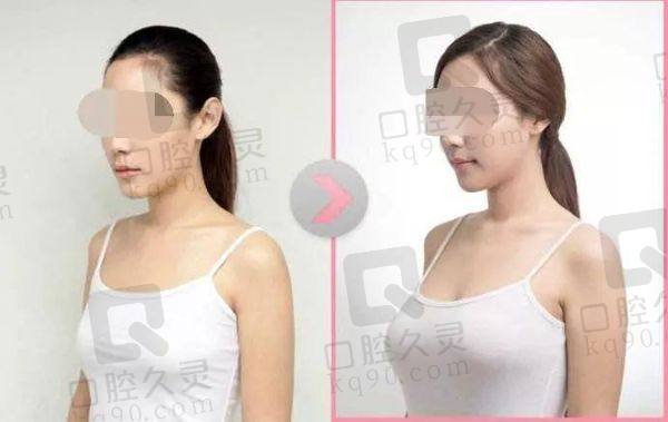 上海华美叶丽萍隆胸价格表