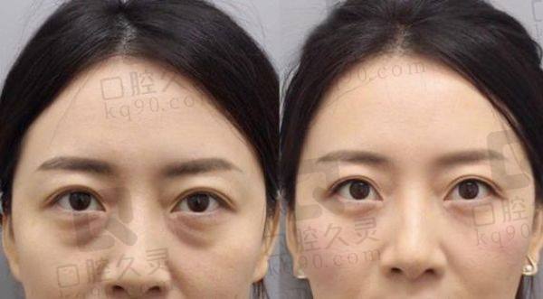 賀潔眼外翻一般要多少錢
