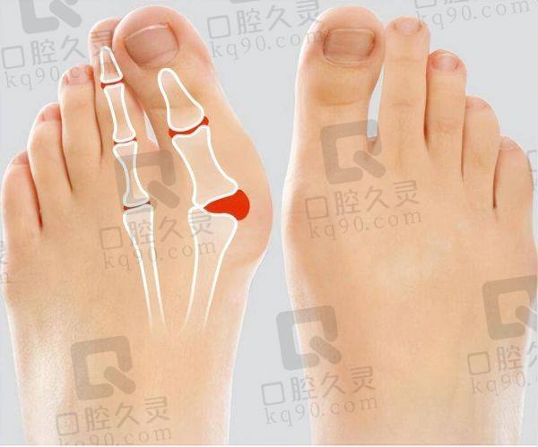 北京圣嘉新大脚骨矫正技术怎么样