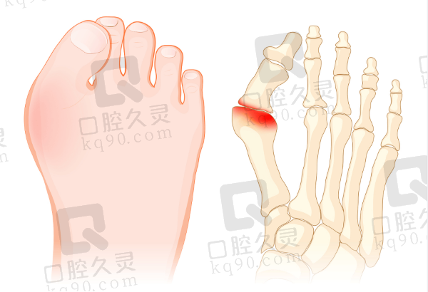 北京圣嘉新大脚骨矫正怎么样