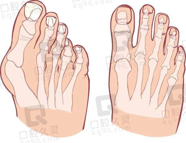 北京圣嘉新大脚骨矫正价格贵吗