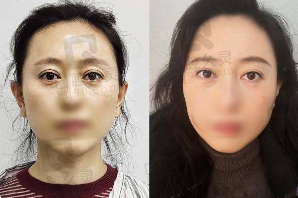 沈阳陈军双眼皮修复怎么样