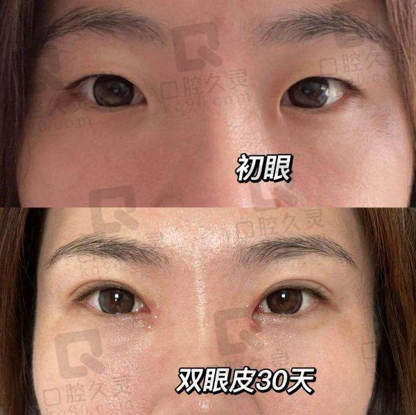 沈阳陈军双眼皮修复多少钱