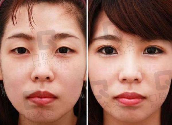 师丽丽双眼皮修复价格