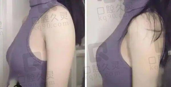 陈成医生隆胸优势