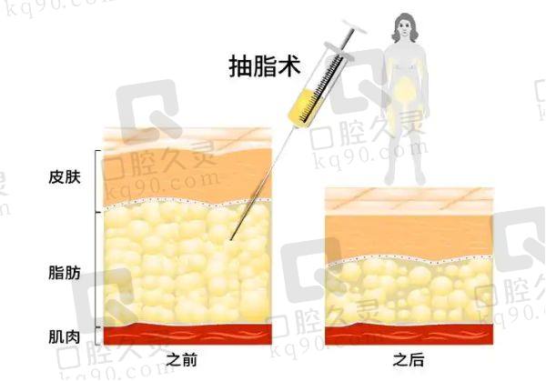 成都军大腰腹吸脂价格