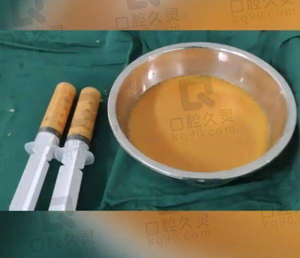 成都军大吸脂的技术优势