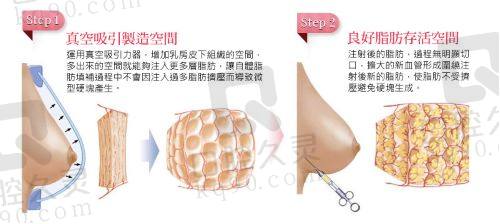 商洛美丽人生整形医院隆胸怎么样