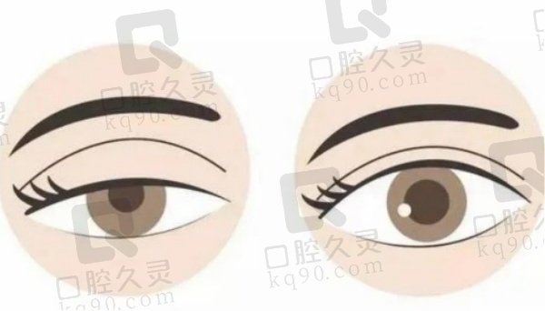 成都游曉波醫(yī)生雙眼皮實(shí)例多
