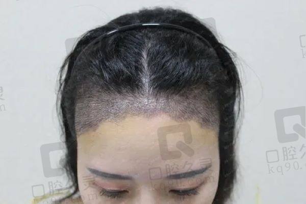 东莞青逸植发医院植发怎么样