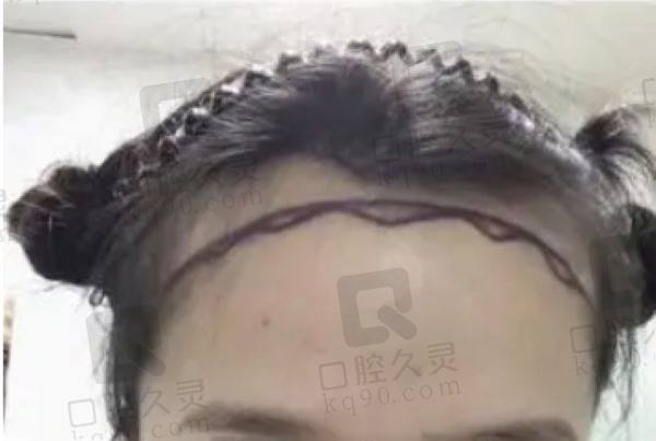 东莞科生植发医院植发怎么样