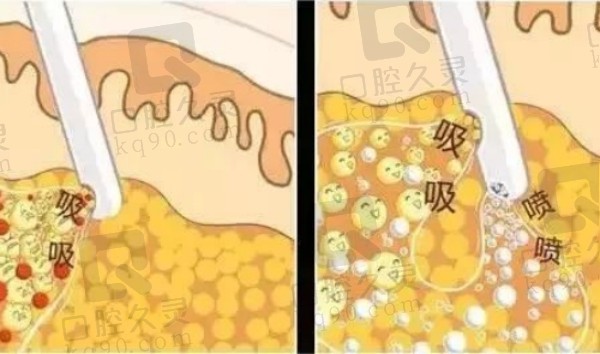 李瑶医生吸脂真实手术实例分析与求美者反馈