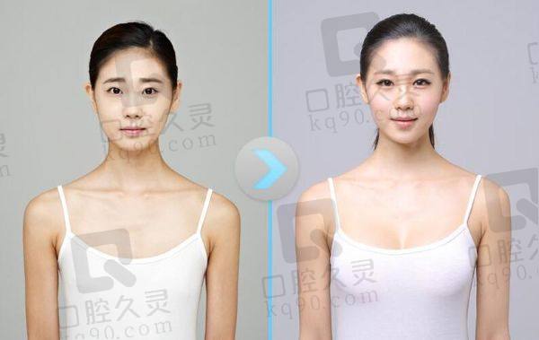 上海华美李健医生隆胸多少钱