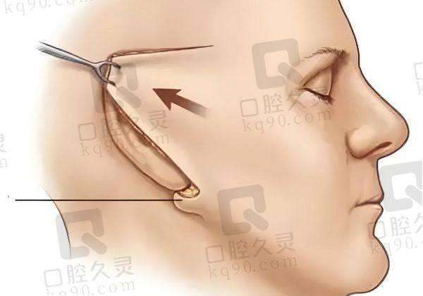 北京陈凤超拉皮多少钱