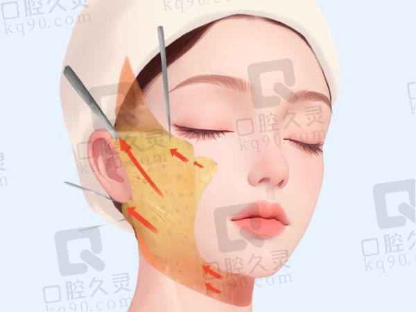 北京陈凤超拉皮口碑评价