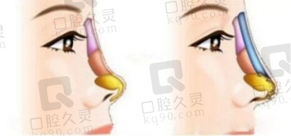 上海联合丽格范荣杰医生的挛缩鼻修复实例