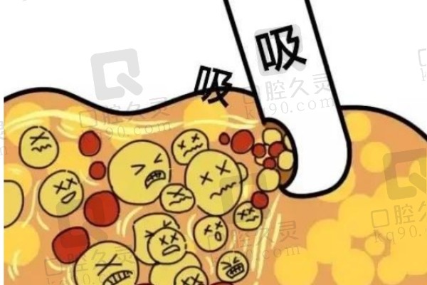 潘红伟医生吸脂价格参考