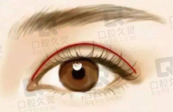王冀耕内眼角修复价格