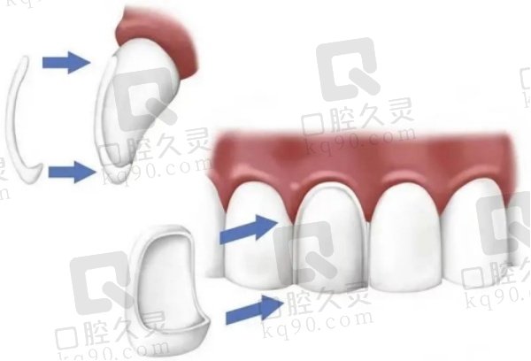南京正规口腔医院牙贴面价格