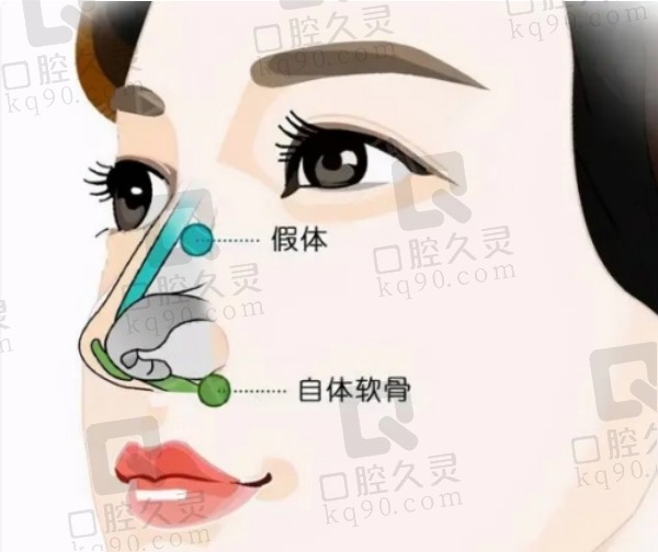 林氏原生鼻技術(shù)特點解析