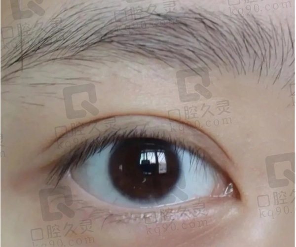 王莉莉醫(yī)生雙眼皮手術(shù)的真實實例分享