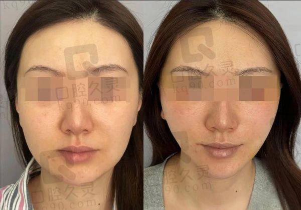 成都东篱医院整形美容科割双眼皮怎么样