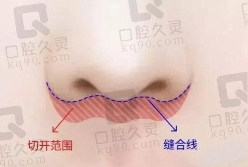 胡俊杰医生的人中缩短手术有哪些特点？
