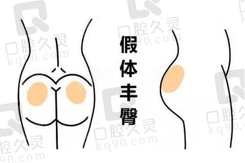胡俊杰医生的假体丰臀术有何优势？