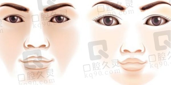 上海卢九宁人中缩短术怎么样