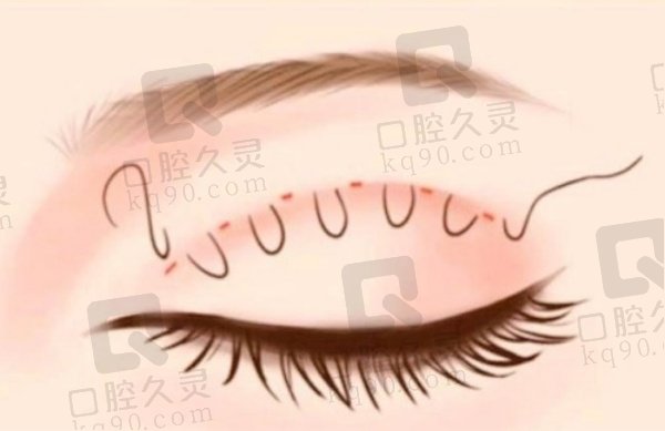 武汉张倩倩双眼皮修复怎么样