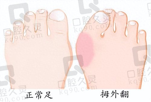 广州广大医院陈碧顺医生的拇外翻矫正技术怎么样？